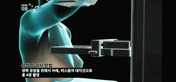 ㅋㅋ 유방암 검사 맘모그래피 고통 납작 압착 찌부 압축 으악